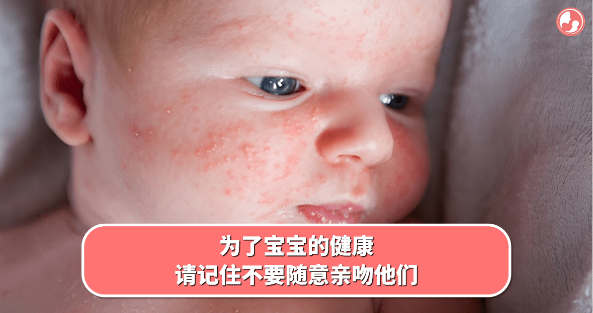 【疱疹篇】为了宝宝的健康，请记住不要随意亲吻他们 -MamaClub