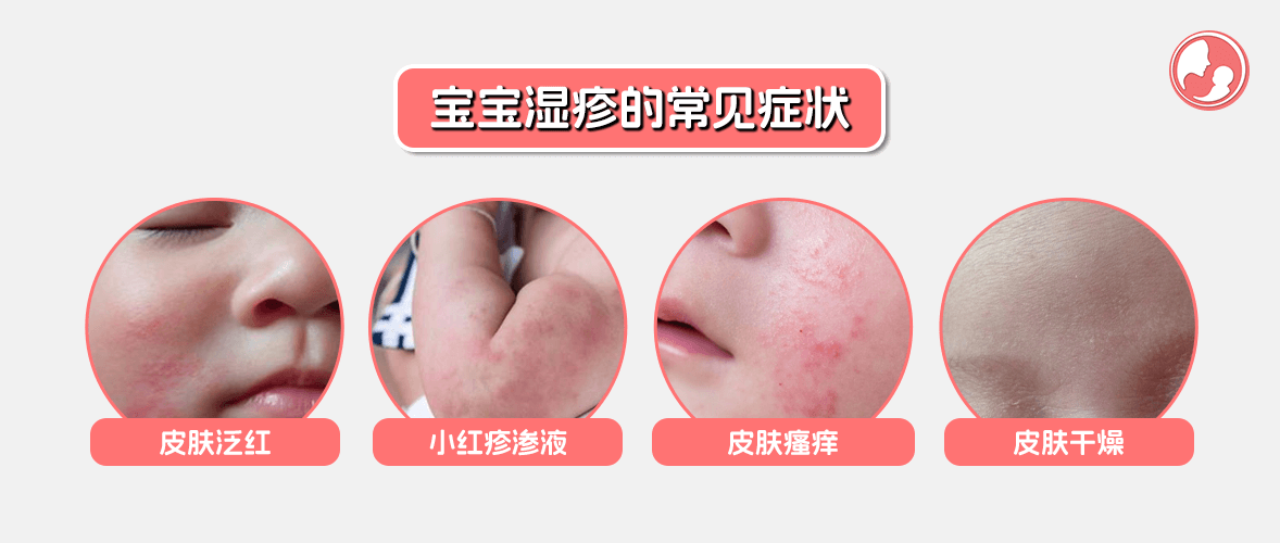 宝宝湿疹的常见症状