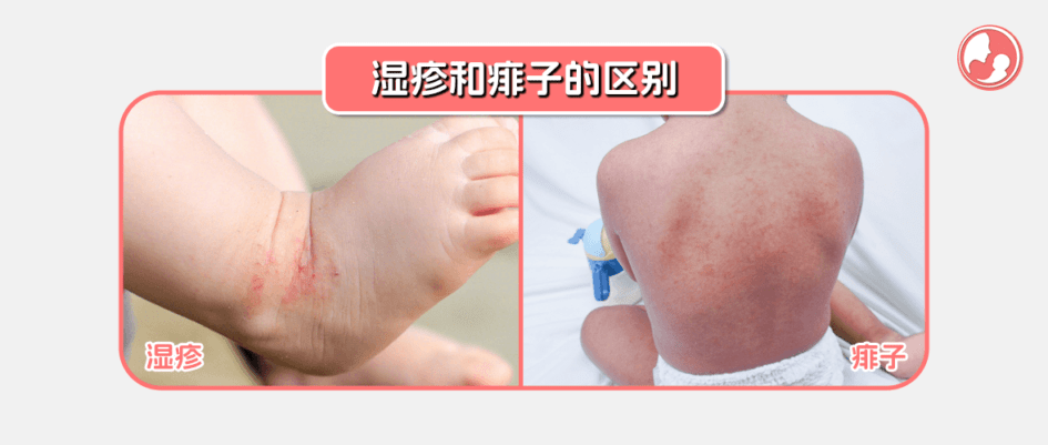 湿疹和痱子的区别