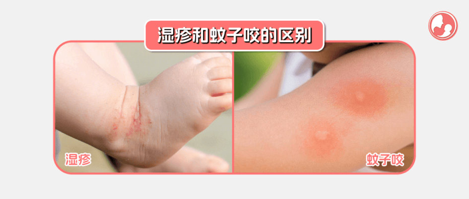 湿疹和蚊子咬的区别
