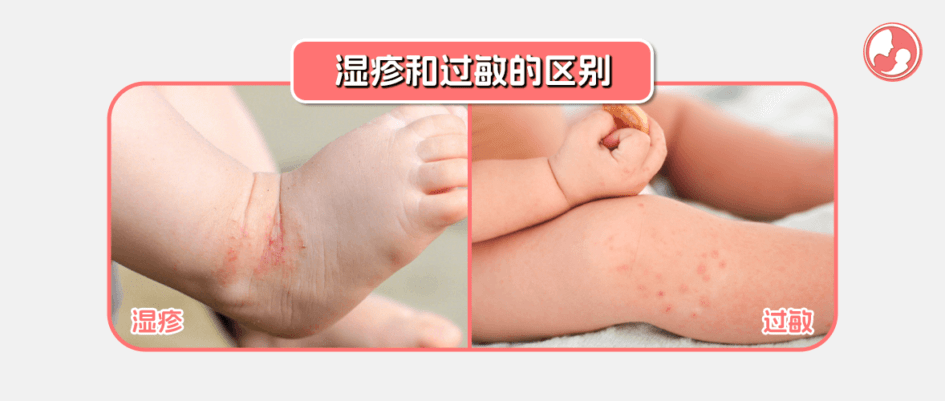湿疹和过敏的区别