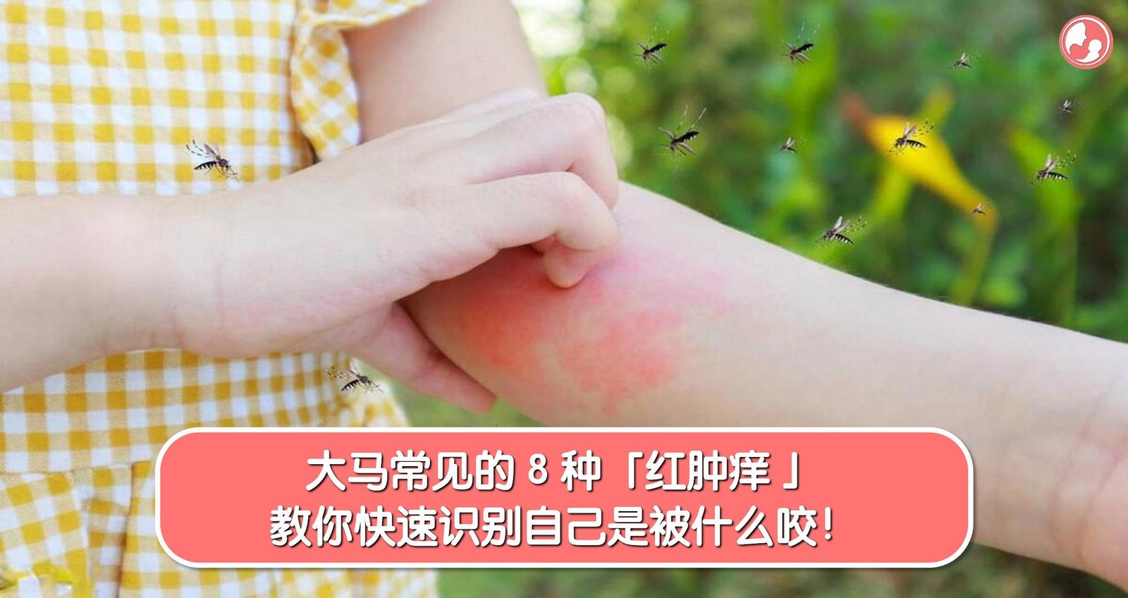 大马常见的 8 种「红肿痒 」，教你快速识别自己是被什么咬！ -MamaClub